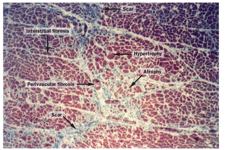 Figure 10. Myocardium (post mortem tissue) in hypersensitive heart disease. Weber et al. (2013)